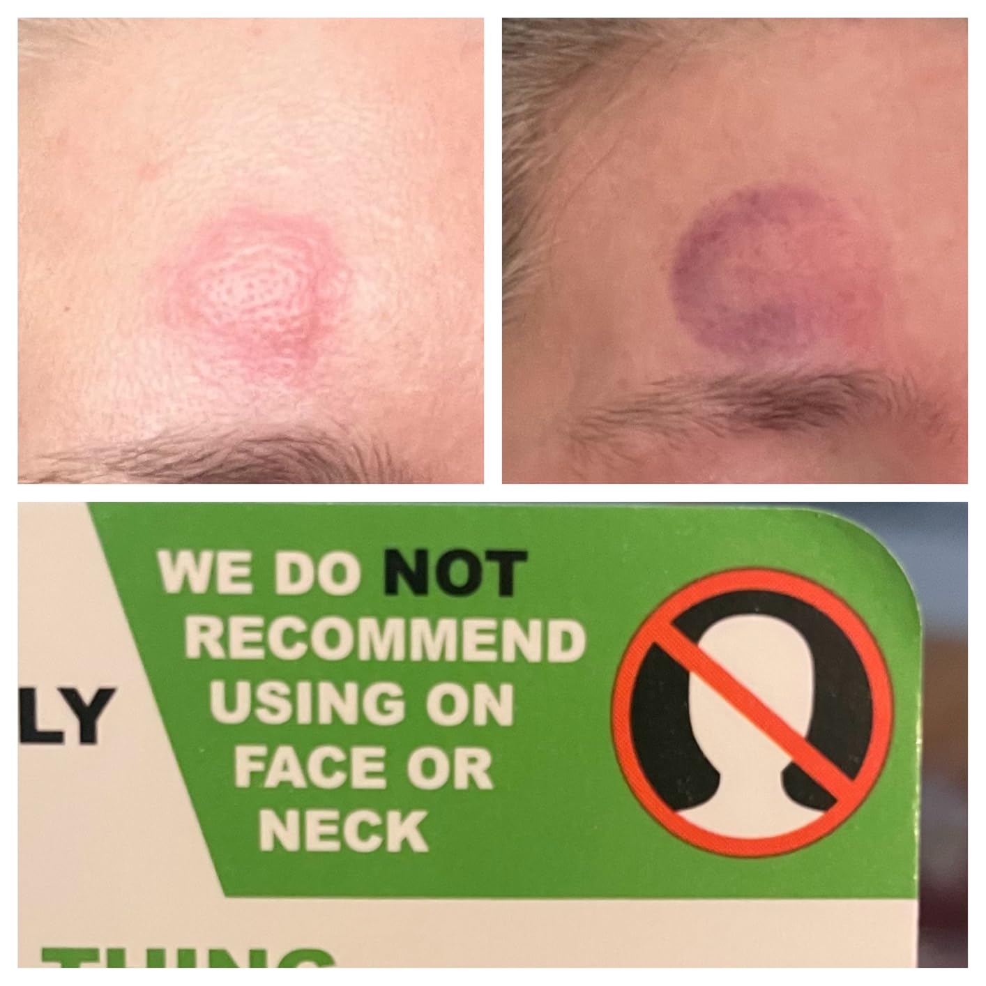 Bug Bite Thing Suction Tool - Bug Bites and Bee/Wasp Stings, Natural Insect Bite Relief, Chemical Free, White customer photo 1