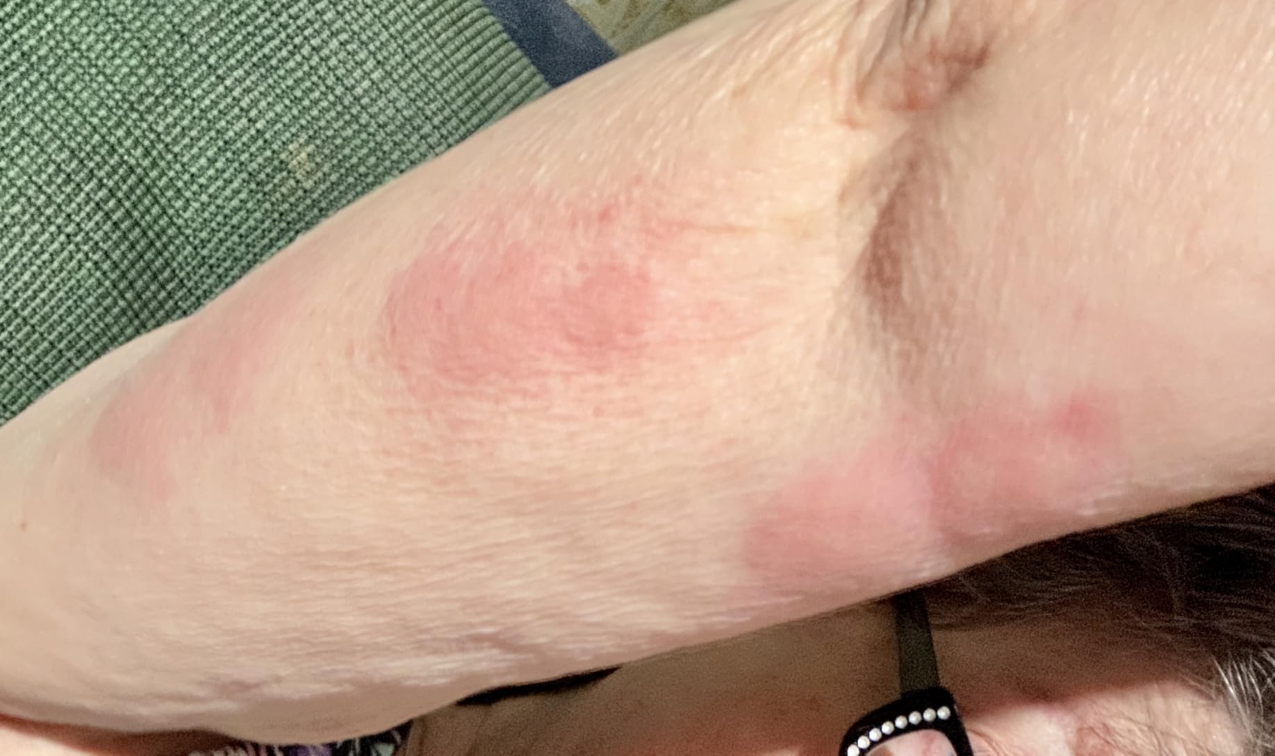After Bite Advanced Formula - Itch Relief with Sodium Bicarbonate - Ideal for Mosquito & Fire Ant Bites, Bees & More - Portable Pen Applicator - 0.5 oz (4 Pack) customer photo 1