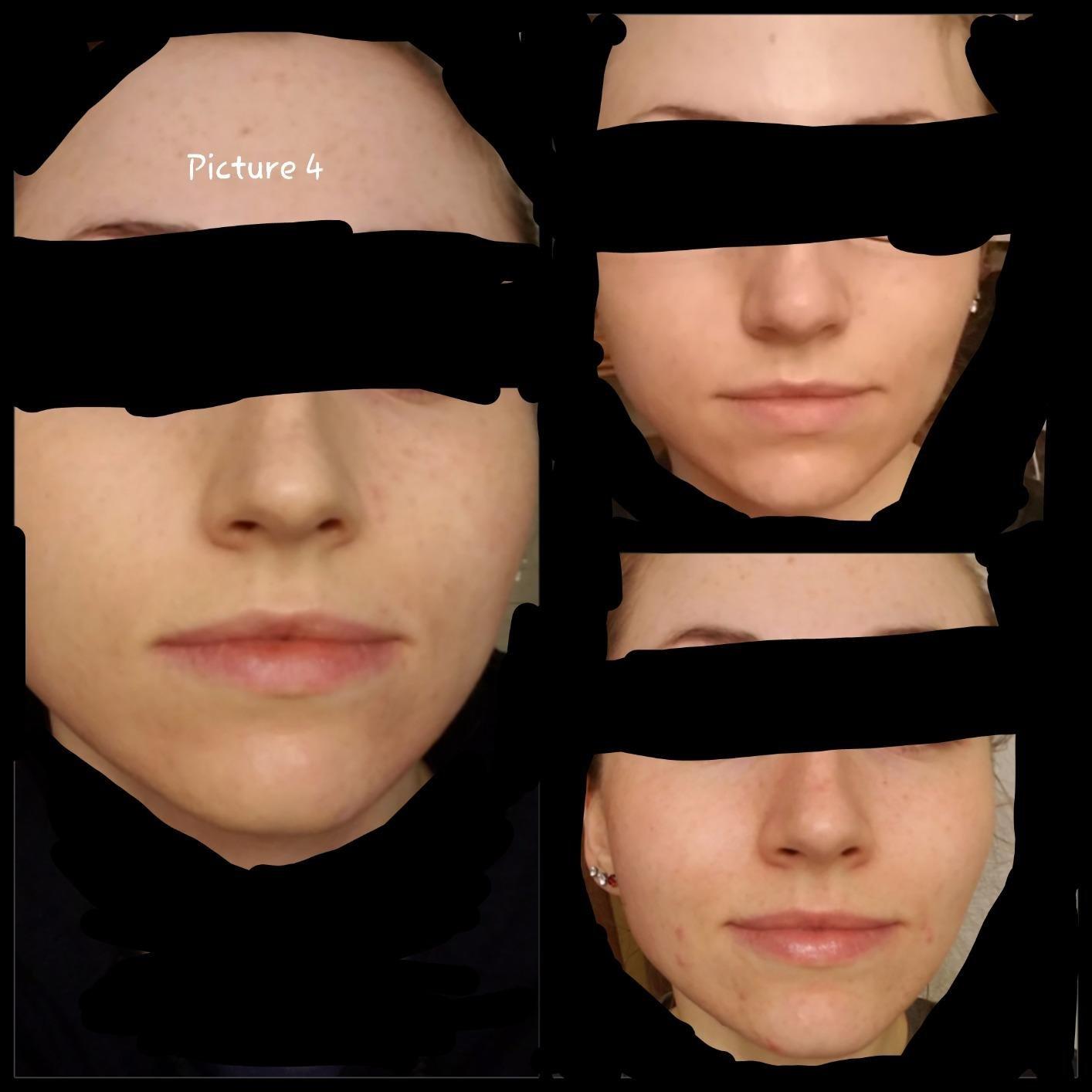 CeraVe Renewing Salicylic Acid Cleanser, Gentle Exfoliating Face Wash, 16oz customer photo 1