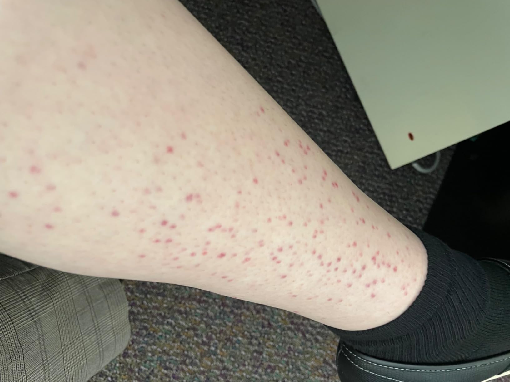 Braun IPL, Silk·Expert Pro 5, IPL Hair Removal for Women and Men, Permanent Laser Hair Reduction At-Home, 4 Heads, IPL5347 customer photo 1